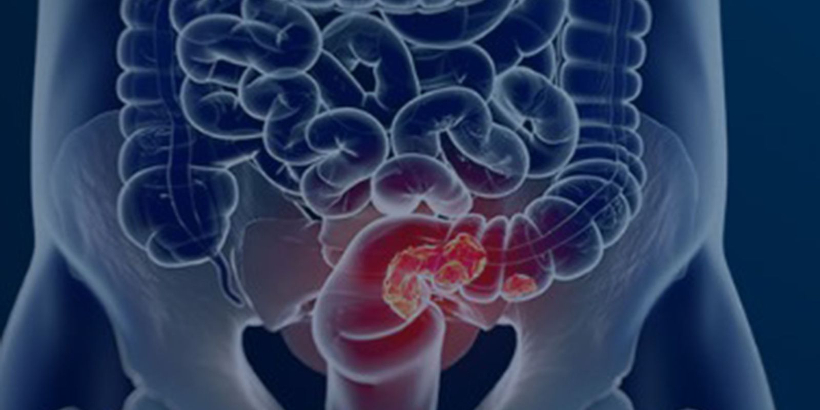 Rastreamento de câncer colorretal no SUS?